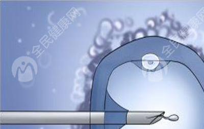 湛江三代试管成功率怎么样？