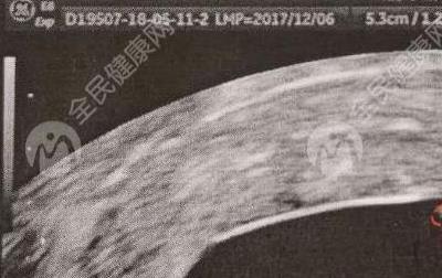 移植囊胚后不着床几天死掉？