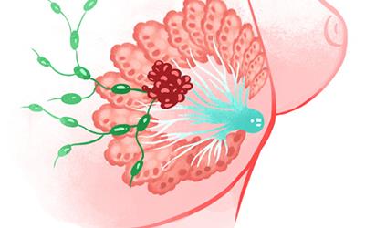 乳腺结节4a类严重吗